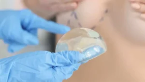 Mellnagyobbítás specialistája: Dr. Fábián Zsolt plasztikai sebész