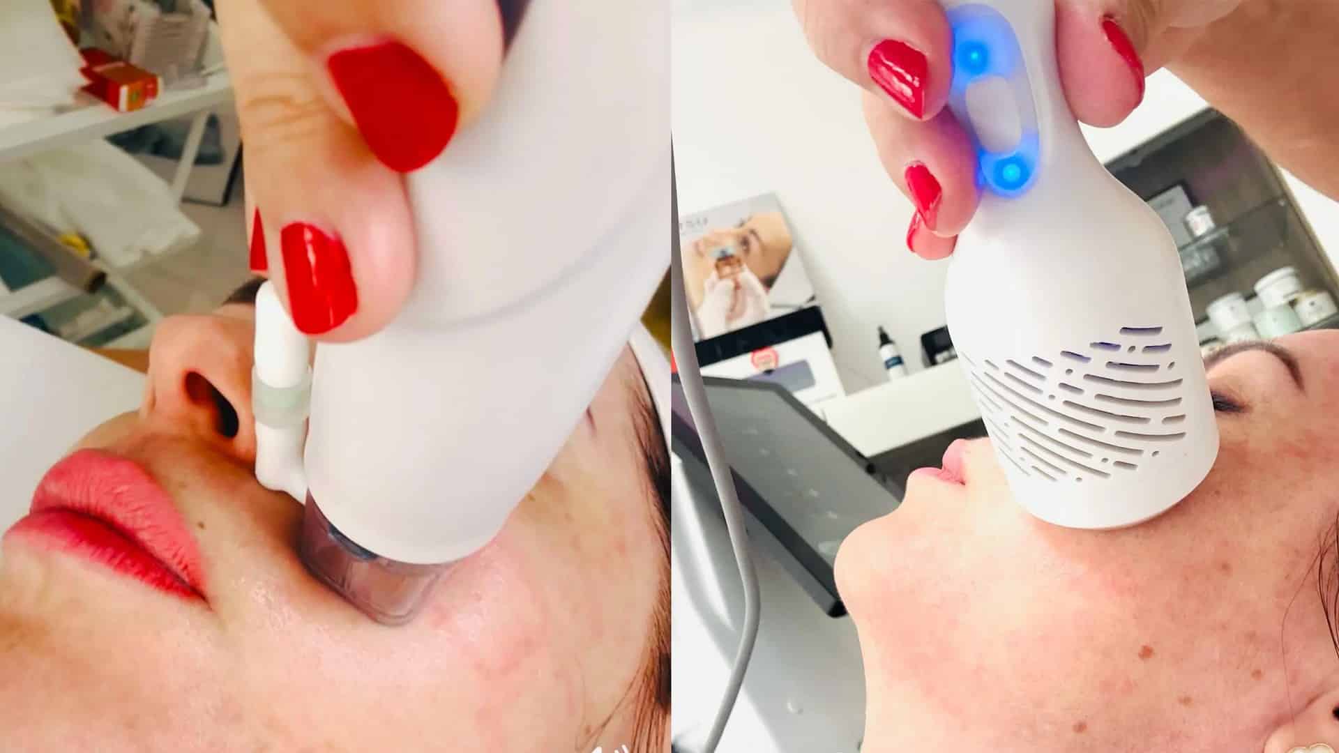 Tűs mezoterápia forradalom Debrecen központjában